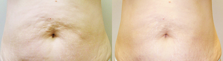 Cellulite-Treatment-in-Northern-Ontario-SKIN-MediSpa-Velashape Before and after
