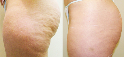 Before and After Cellulaze treatment in Northern Ontario SKIN MediSpa Velashape