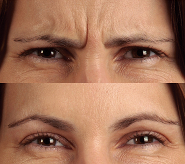 Botox-cosmetic-before-and-after-injections-results-sudbury-ontario-skin-medispa-ontario-frownlines-2-Courtesy-of-Botox