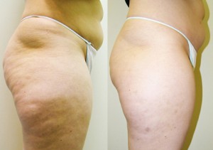 Cellulite-Treatment-in-Northern-Ontario-SKIN-MediSpa-Velashape