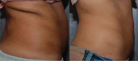 Cellulite-Treatment-in-Northern-Ontario-SKIN-MediSpa-Velashape Before and after