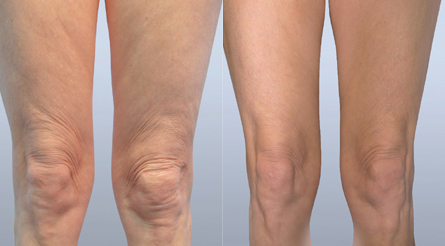 Fractora-Firm-Plus-skin-tightening-anti-aging-sudbury-ontario-skin-medispa-Courtesy-of-Invasix-4