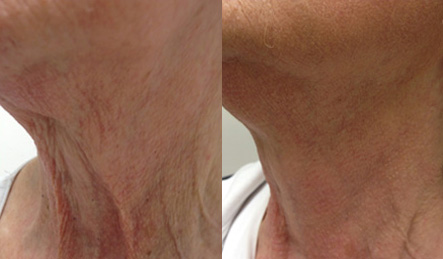 Fractora-fractional-resurfacing-before-and-after-anti-aging-sudbury-ontario-Courtesy-of-Invasix-2
