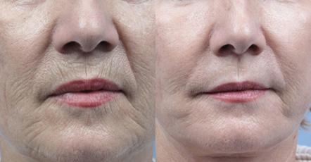 Fractora-fractional-resurfacing-before-and-after-anti-aging-sudbury-ontario-Courtesy-of-Invasix-3