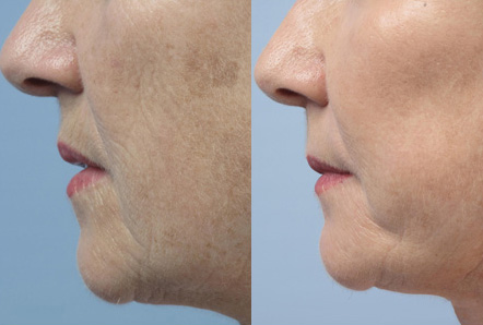 Fractora-fractional-resurfacing-before-and-after-anti-aging-sudbury-ontario-Courtesy-of-Invasix